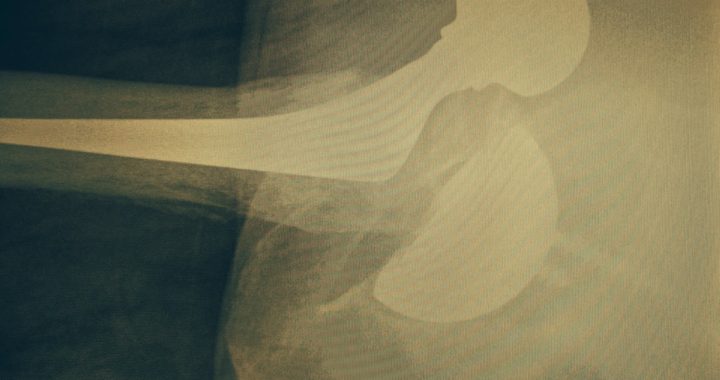 Dislocating Hip