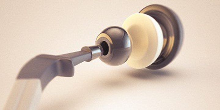 Hip Replacement Revision